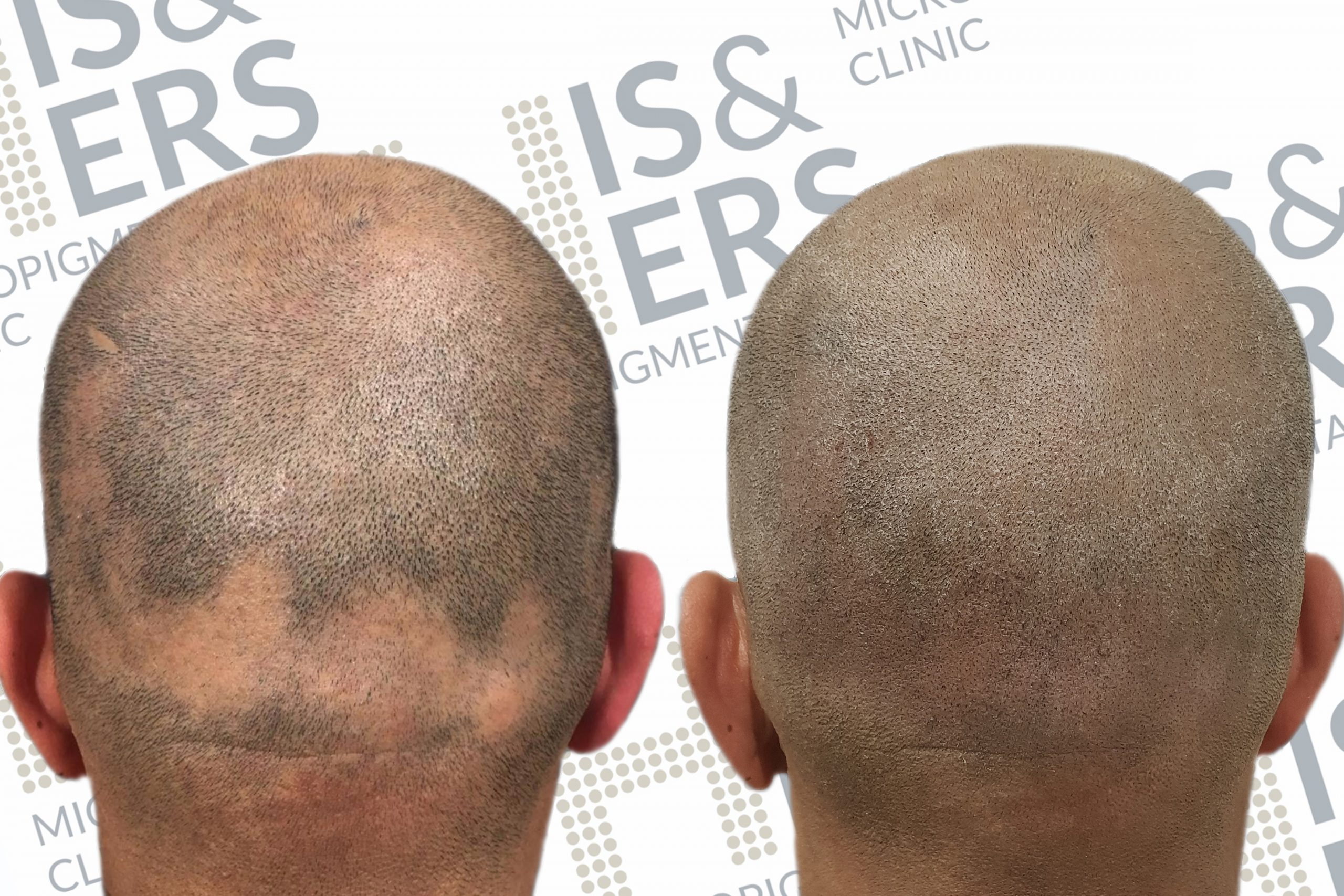 alopecia scalp micropigmentation