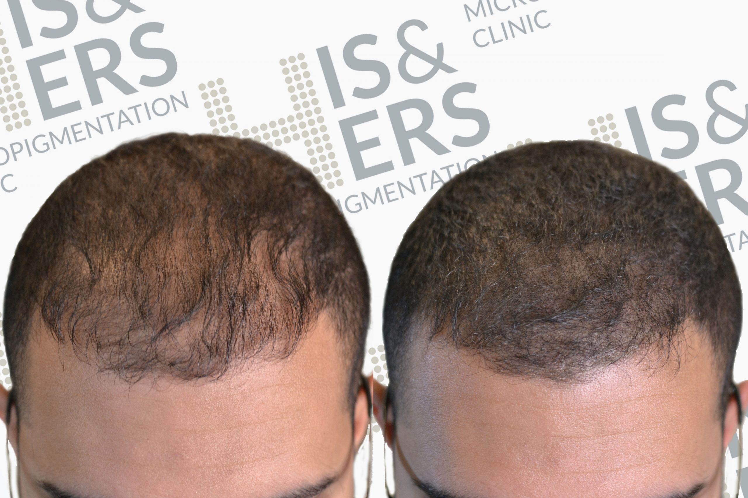 hair thinning scalp micropigmentation density effect