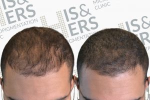 Thinning Hair Density effect scalp pigmentation SMP