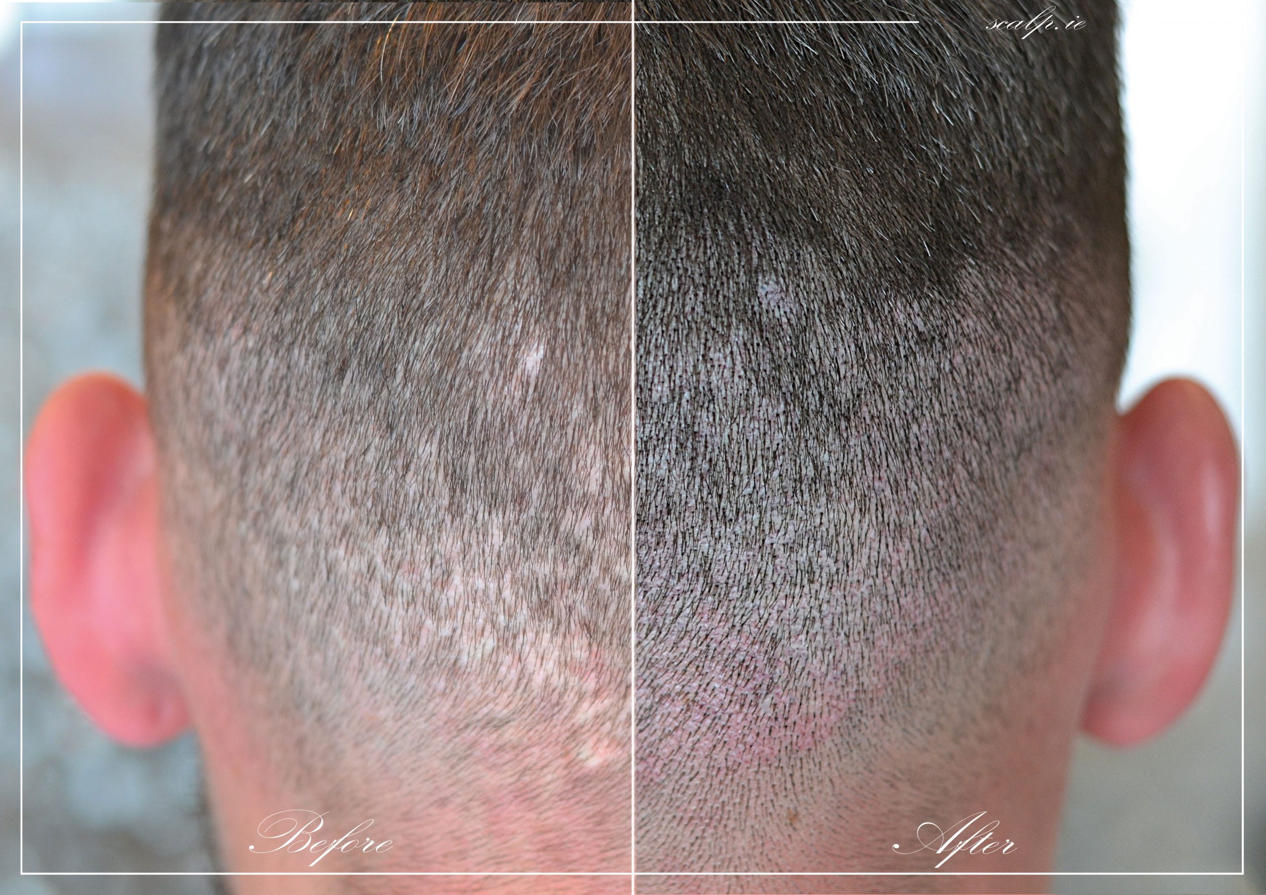 scalp pigmentation scars fut