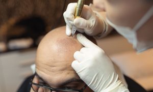 male pattern baldness scalp micropigmentation