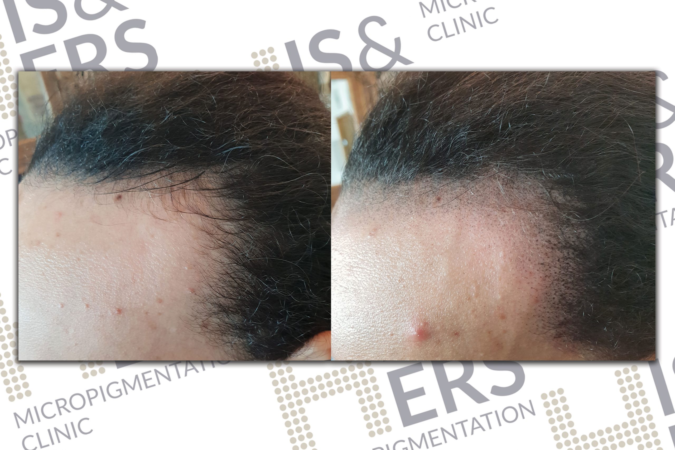 Receeding hairline scalp pigmentation for woman client